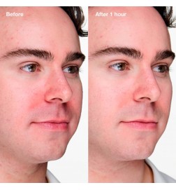 ANTI-BLEMISH SOLUTIONS CLINICAL - 20ml