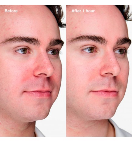 ANTI-BLEMISH SOLUTIONS CLINICAL - 20ml