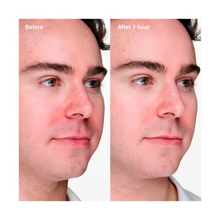 ANTI-BLEMISH SOLUTIONS CLINICAL - 20ml